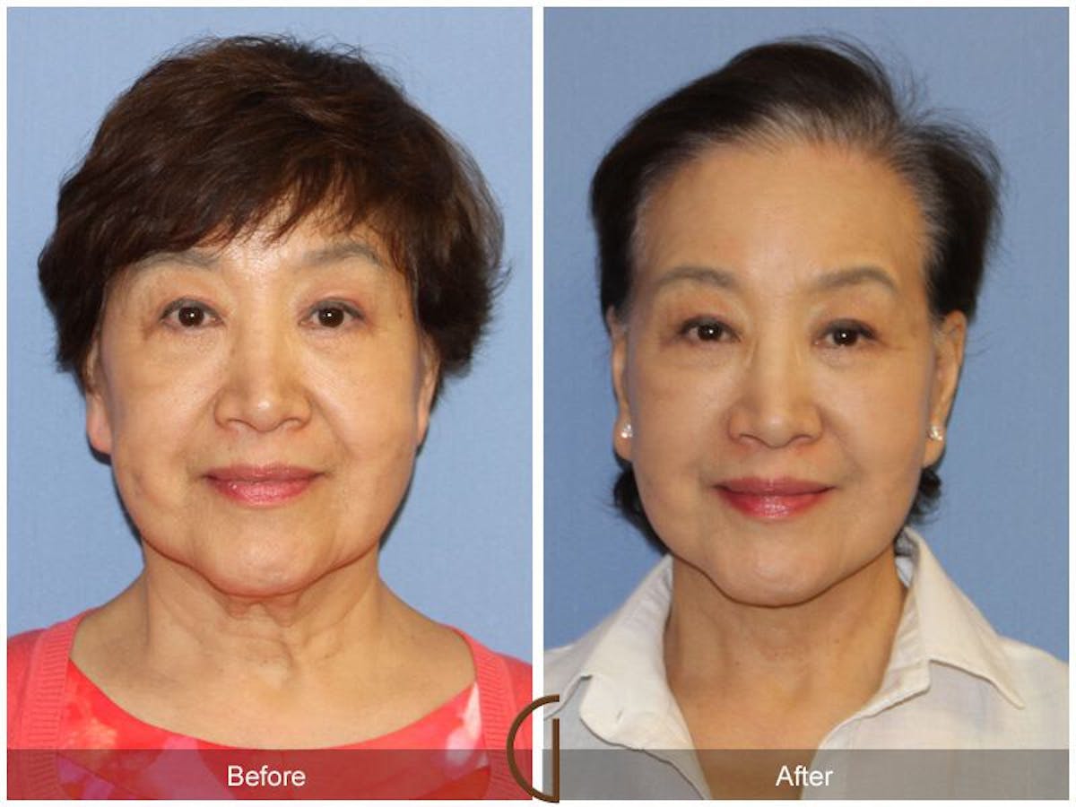Facelift 70s Before & After Gallery - Patient 386180 - Image 2