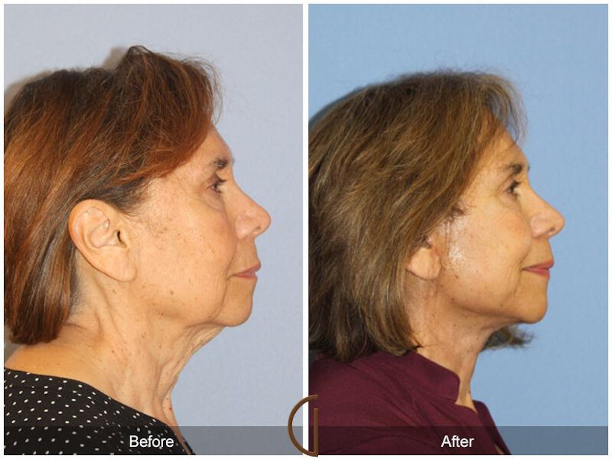 Facelift 70s Before & After Gallery - Patient 168965 - Image 3