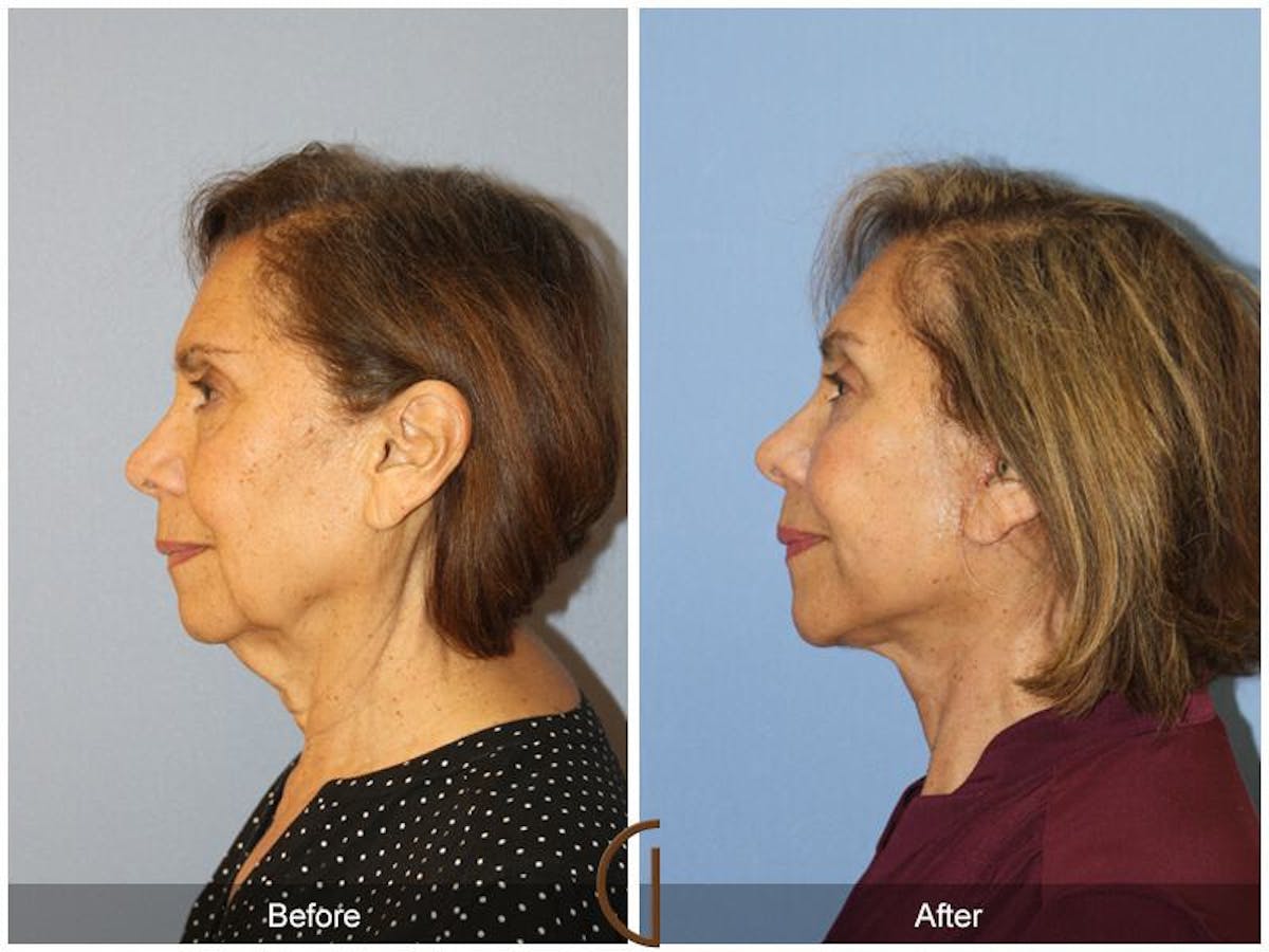 Facelift 70s Before & After Gallery - Patient 168965 - Image 1