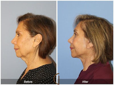 Facelift 70s Before & After Gallery - Patient 168965 - Image 1