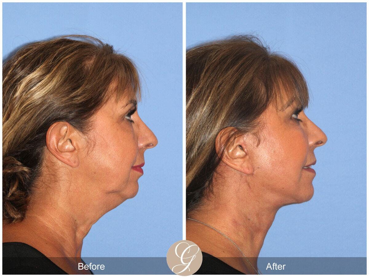 Facelift 60s Before & After Gallery - Patient 154714 - Image 3