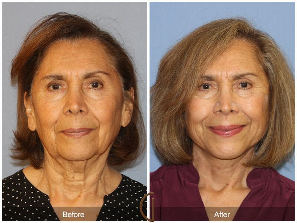 Facelift 70s Before & After Gallery - Patient 168965 - Image 2