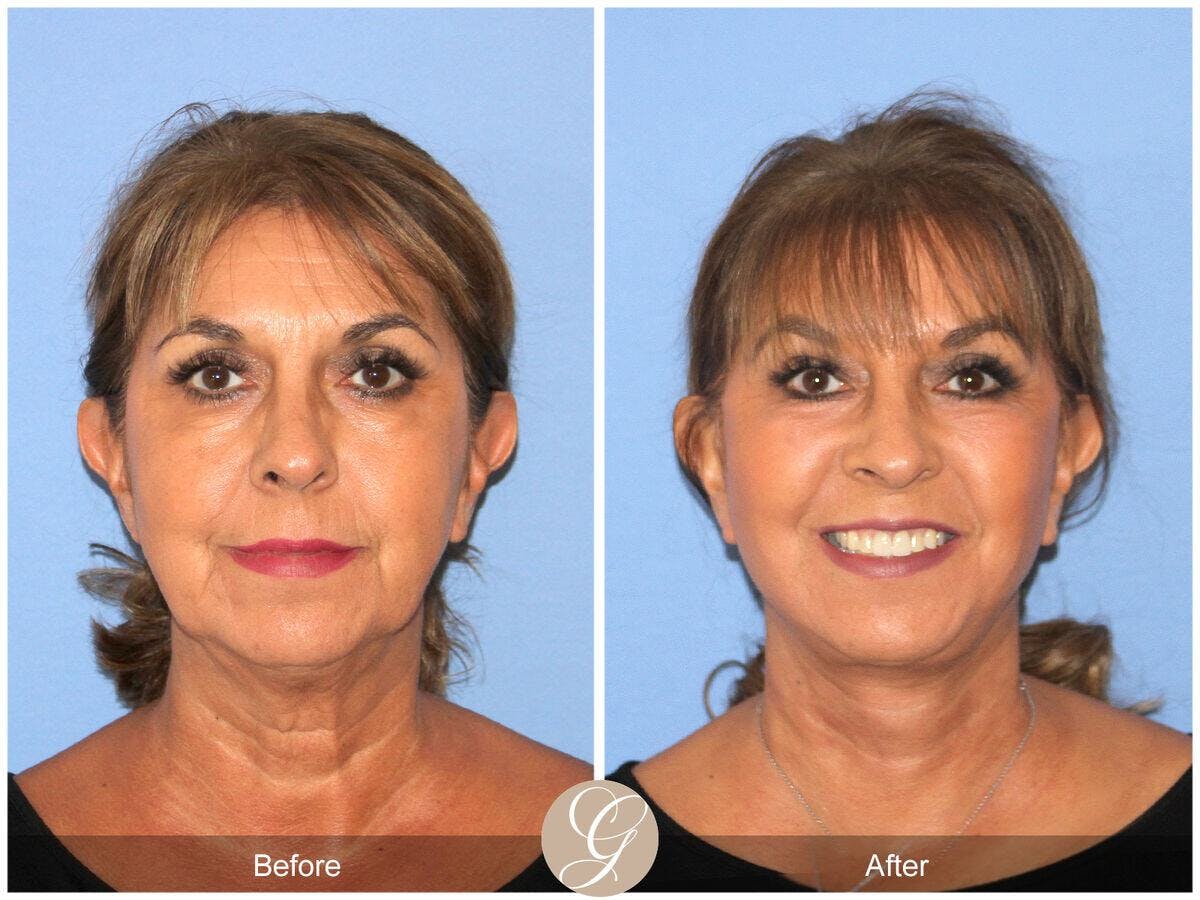 Facelift 60s Before & After Gallery - Patient 154714 - Image 2