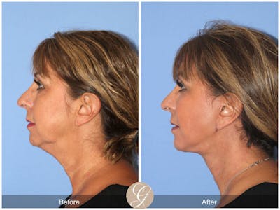 Facelift 60s Before & After Gallery - Patient 154714 - Image 1
