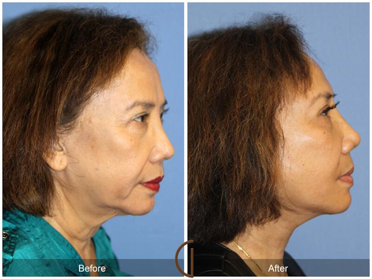 Facelift 60s Before & After Gallery - Patient 392795 - Image 3