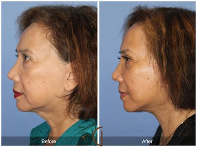 Facelift 60s Before & After Gallery - Patient 392795 - Image 1