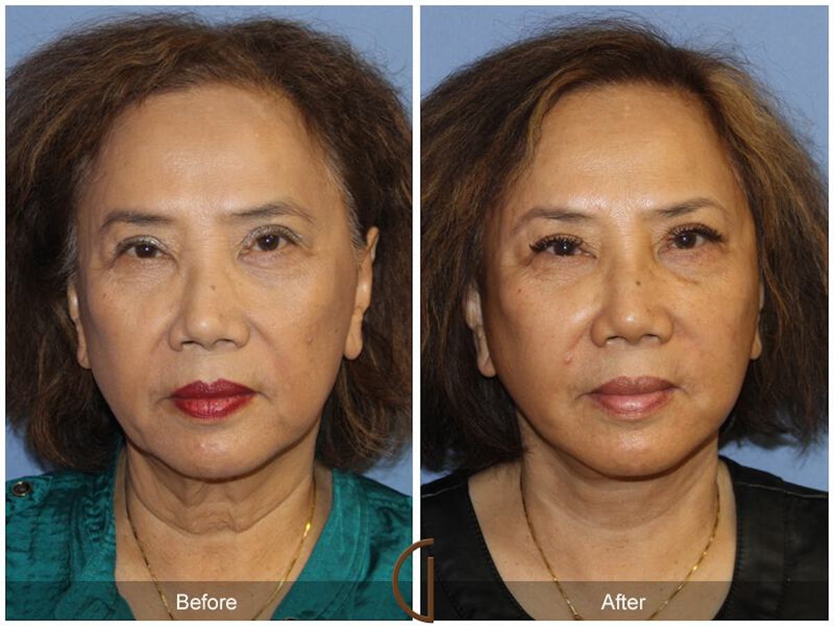 Facelift 60s Before & After Gallery - Patient 392795 - Image 2