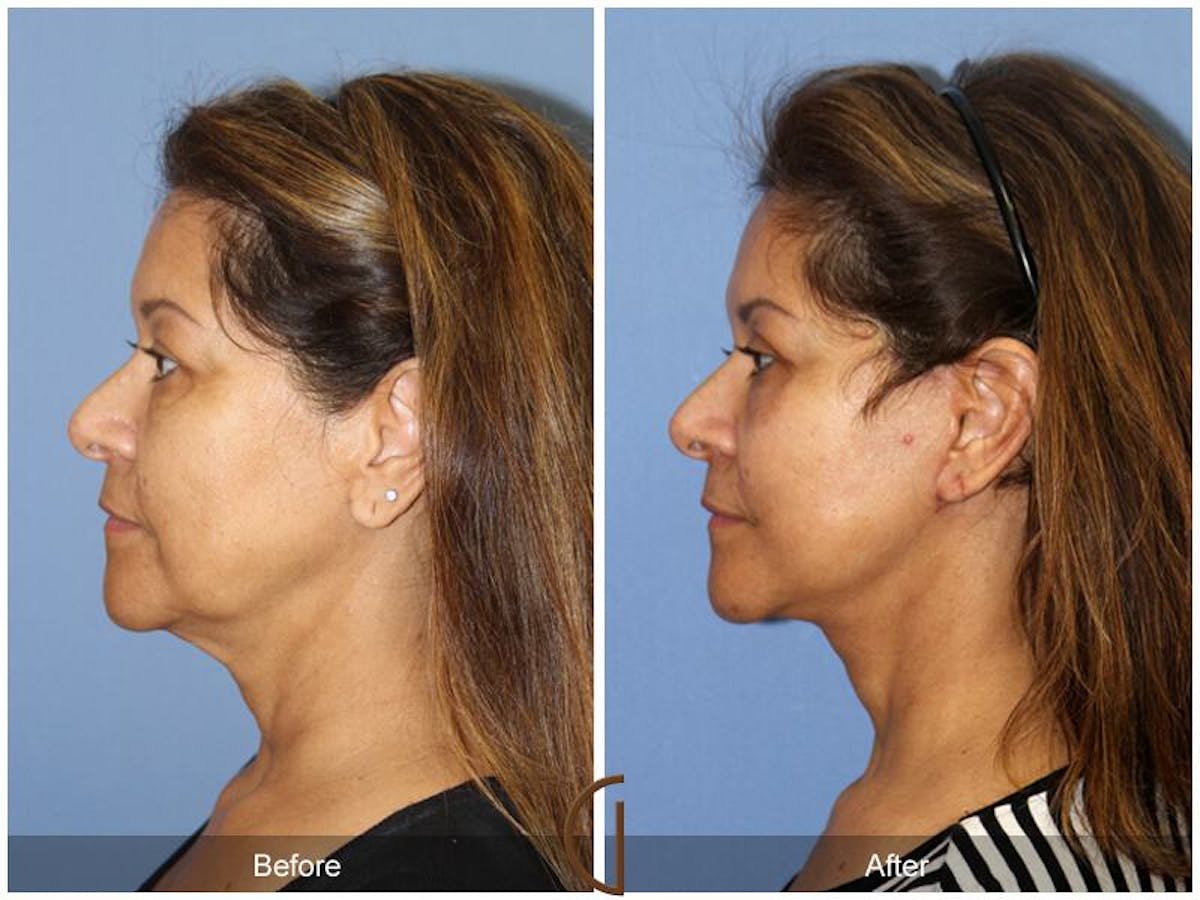 Facelift 50s Before & After Gallery - Patient 130807 - Image 1