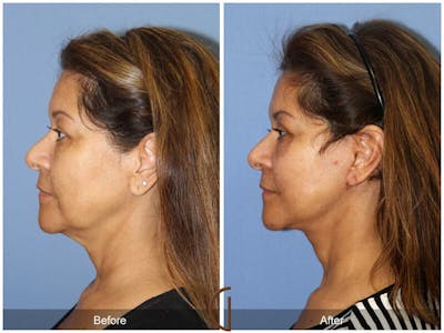 Facelift 50s Before & After Gallery - Patient 130807 - Image 1