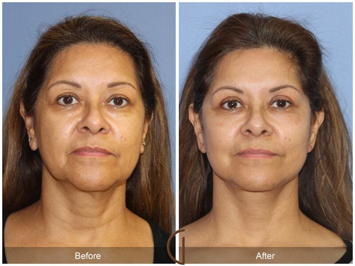 Facelift 50s Before & After Gallery - Patient 130807 - Image 2