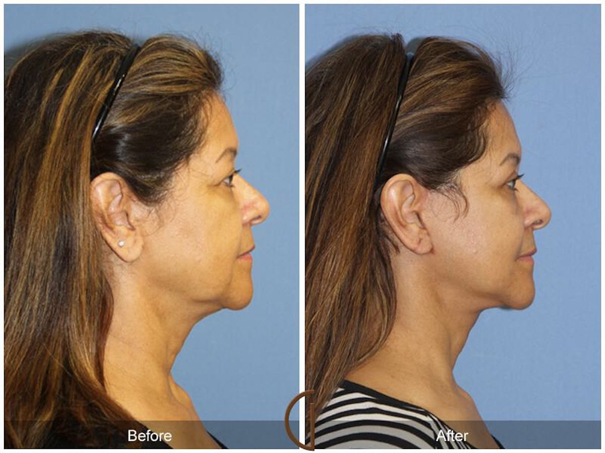 Facelift 50s Before & After Gallery - Patient 130807 - Image 3