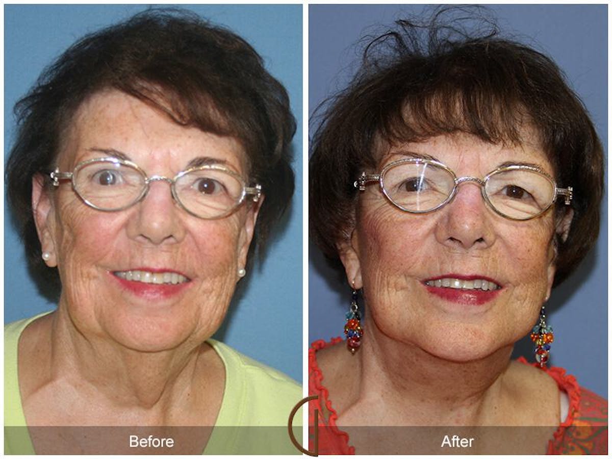 Facelift 70s Before & After Gallery - Patient 264791 - Image 2