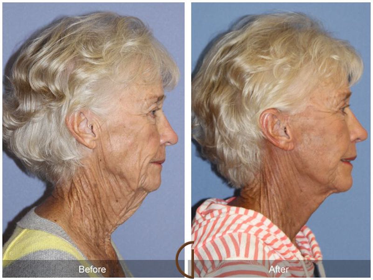 Facelift 70s Before & After Gallery - Patient 260393 - Image 3