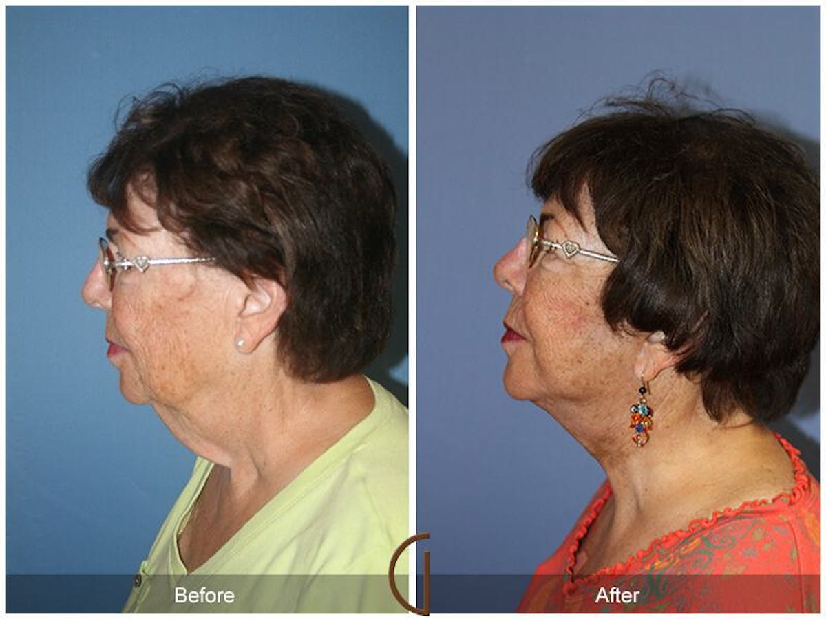Facelift 70s Before & After Gallery - Patient 264791 - Image 1
