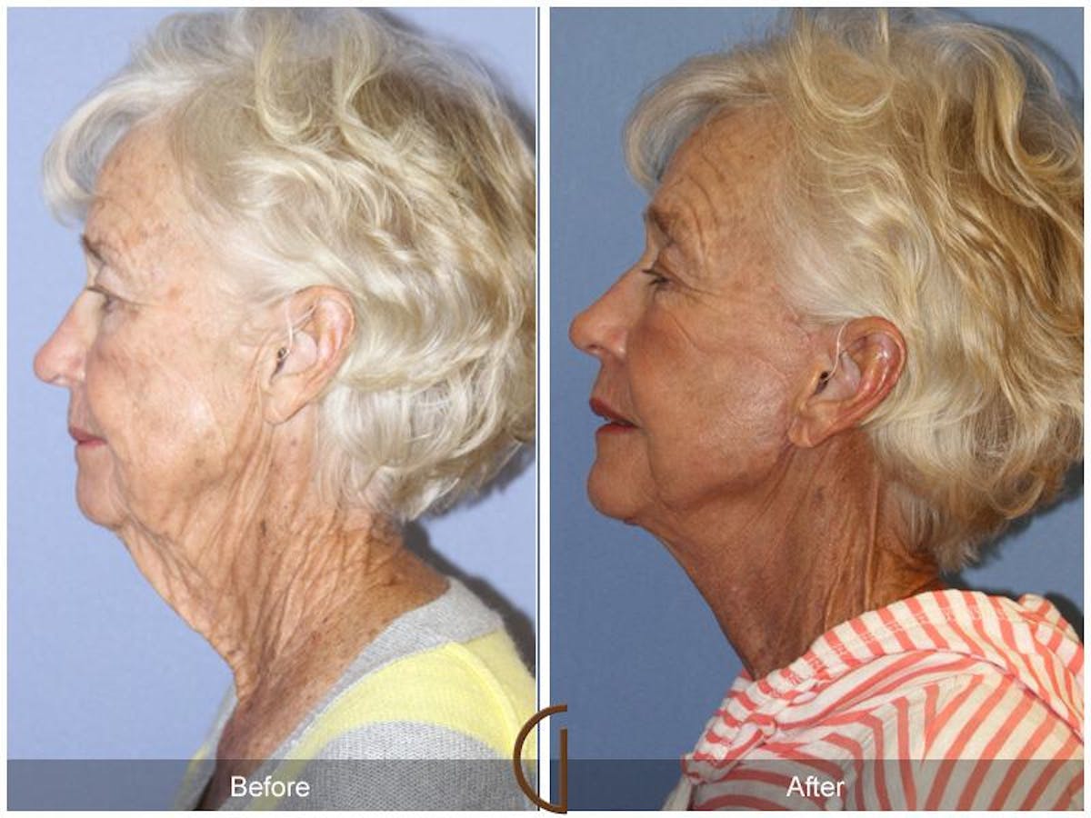 Facelift 70s Before & After Gallery - Patient 260393 - Image 1