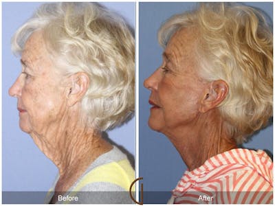 Facelift 70s Before & After Gallery - Patient 260393 - Image 1
