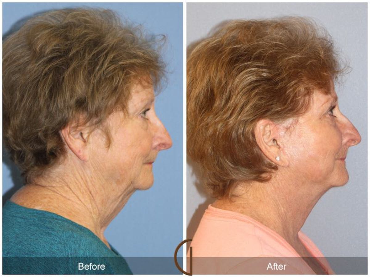 Facelift 70s Before & After Gallery - Patient 274895 - Image 3
