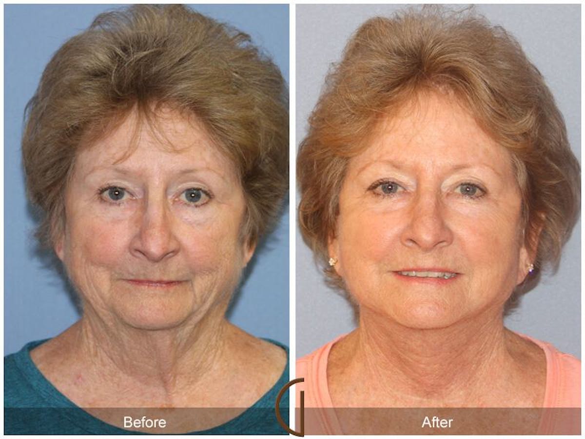 Facelift 70s Before & After Gallery - Patient 274895 - Image 2