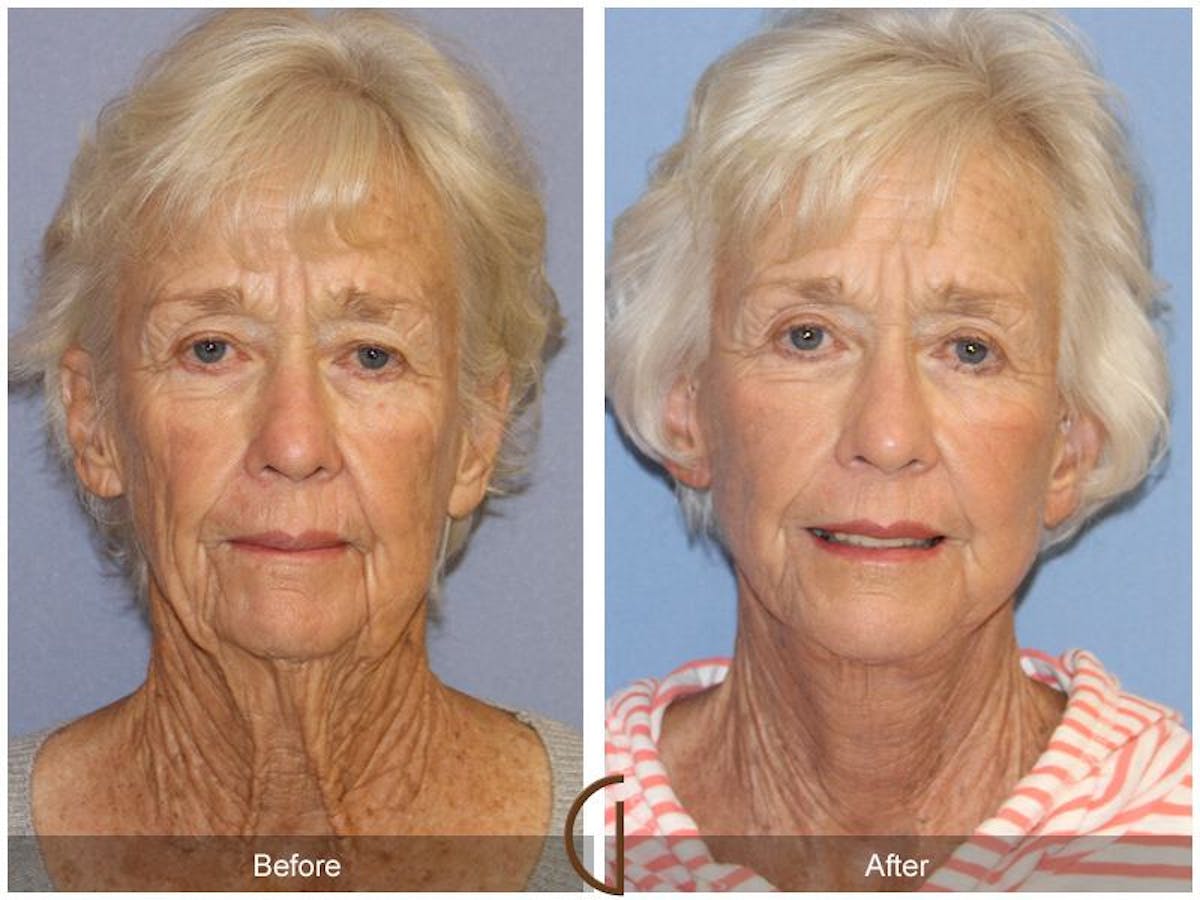 Facelift 70s Before & After Gallery - Patient 260393 - Image 2