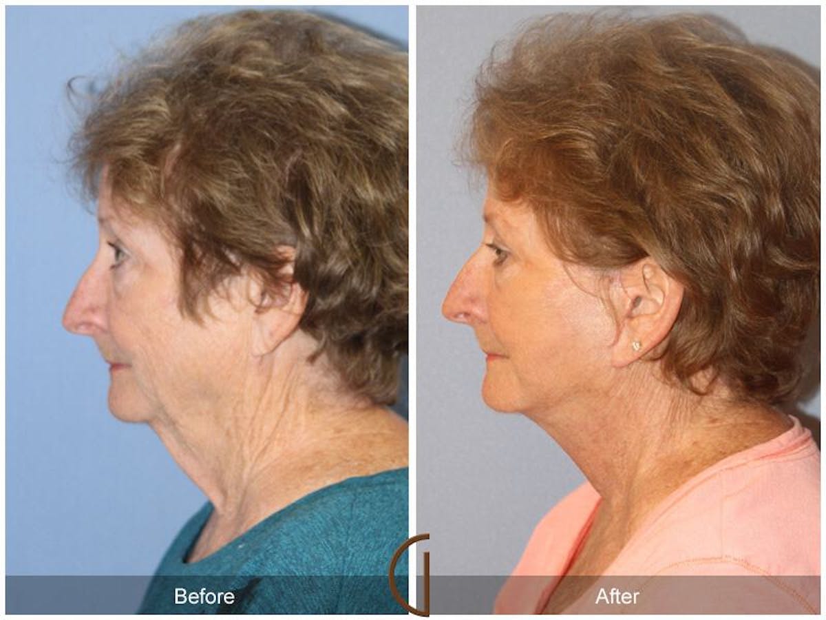 Facelift 70s Before & After Gallery - Patient 274895 - Image 1