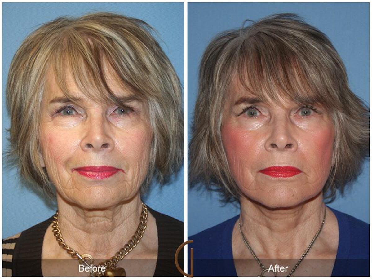 Facelift 70s Before & After Gallery - Patient 198315 - Image 2