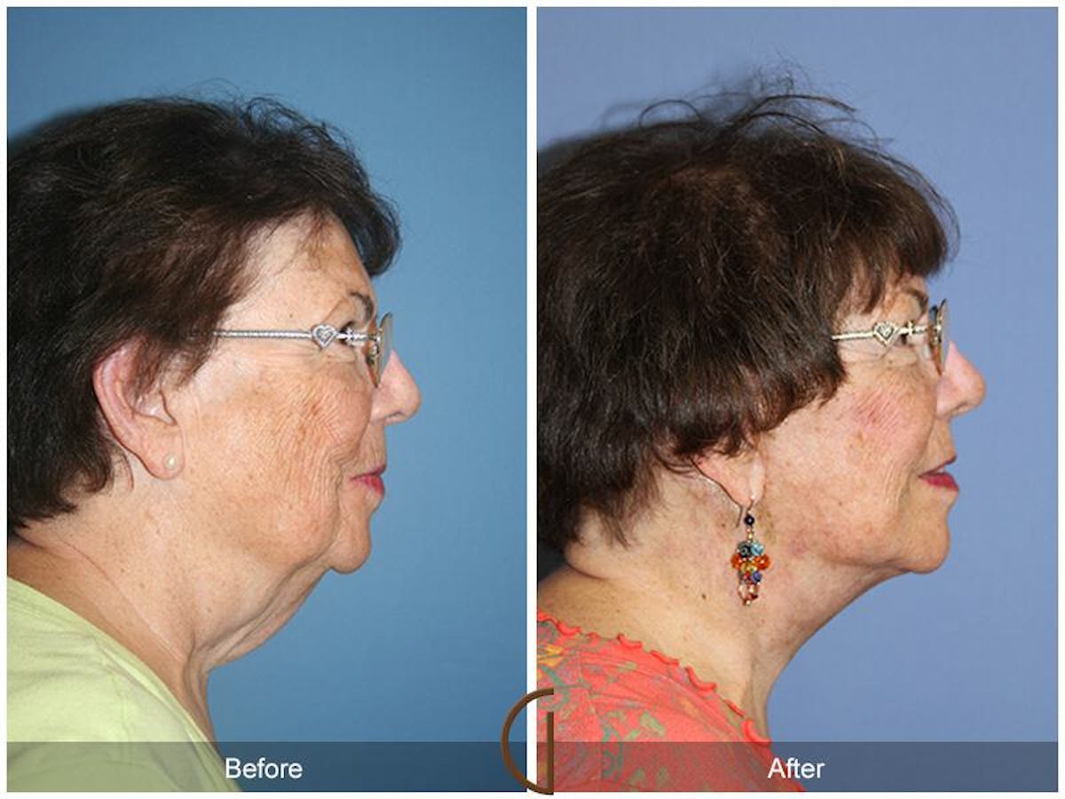 Facelift 70s Before & After Gallery - Patient 264791 - Image 3