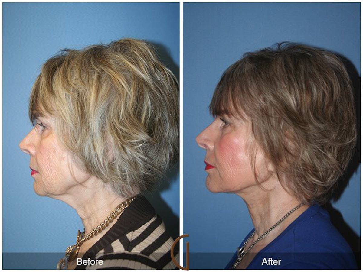 Facelift 70s Before & After Gallery - Patient 198315 - Image 1
