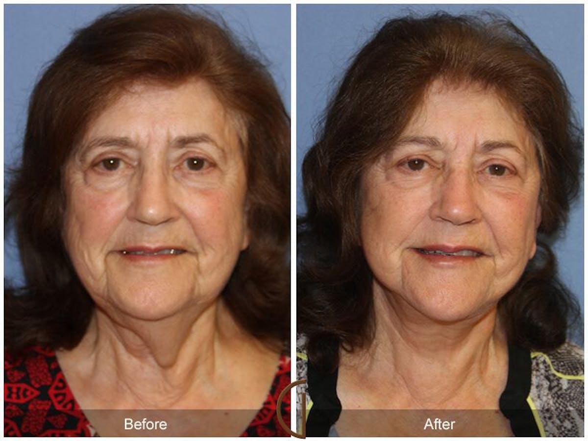 Facelift 70s Before & After Gallery - Patient 396349 - Image 2