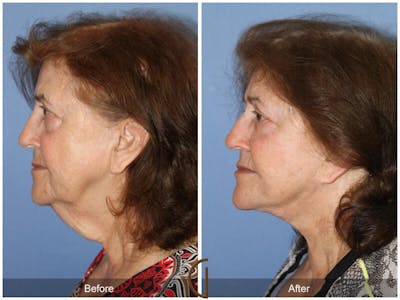Facelift 70s Before & After Gallery - Patient 396349 - Image 1