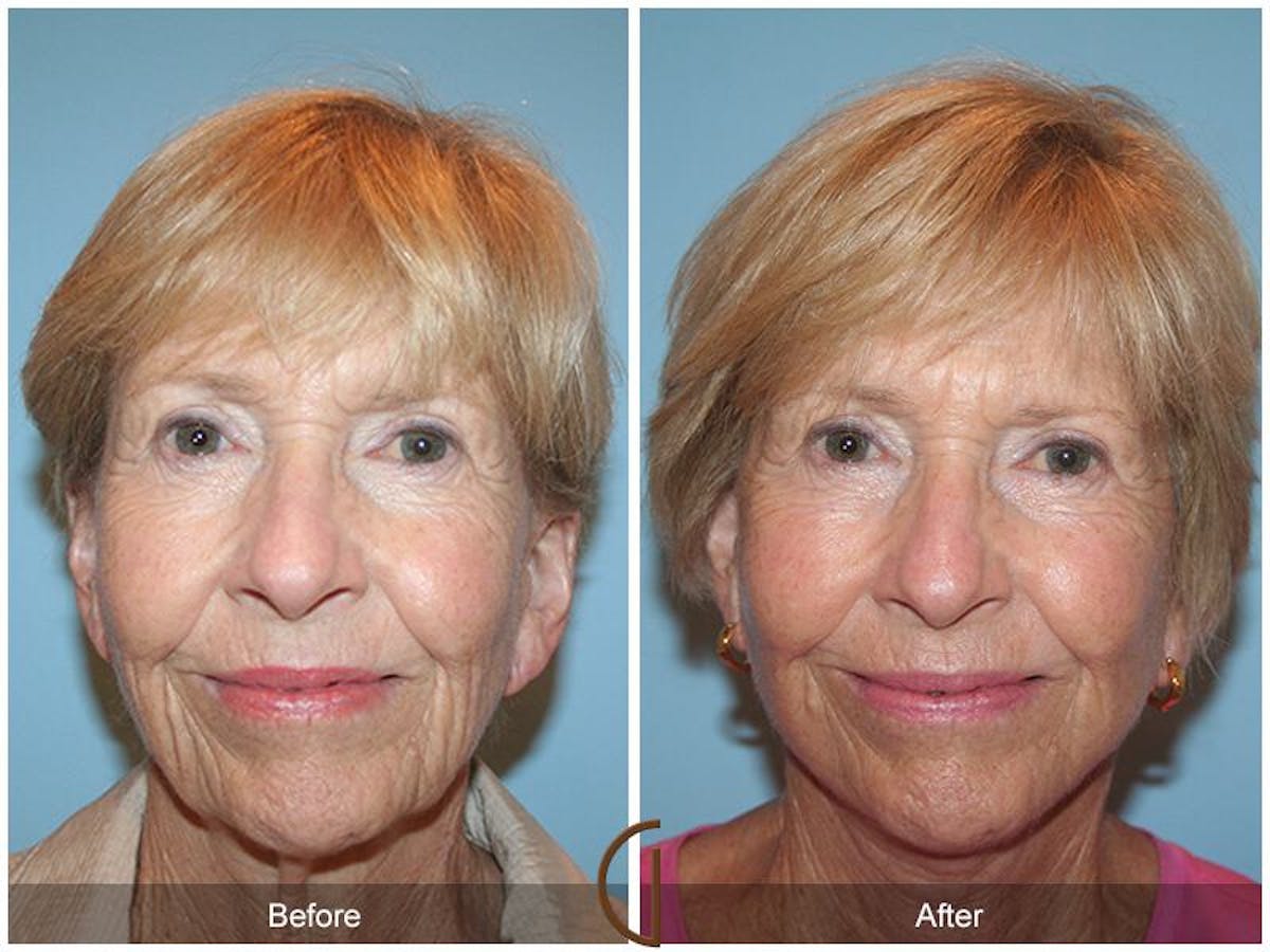 Facelift 70s Before & After Gallery - Patient 336254 - Image 2