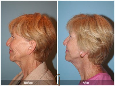 Facelift 70s Before & After Gallery - Patient 336254 - Image 1