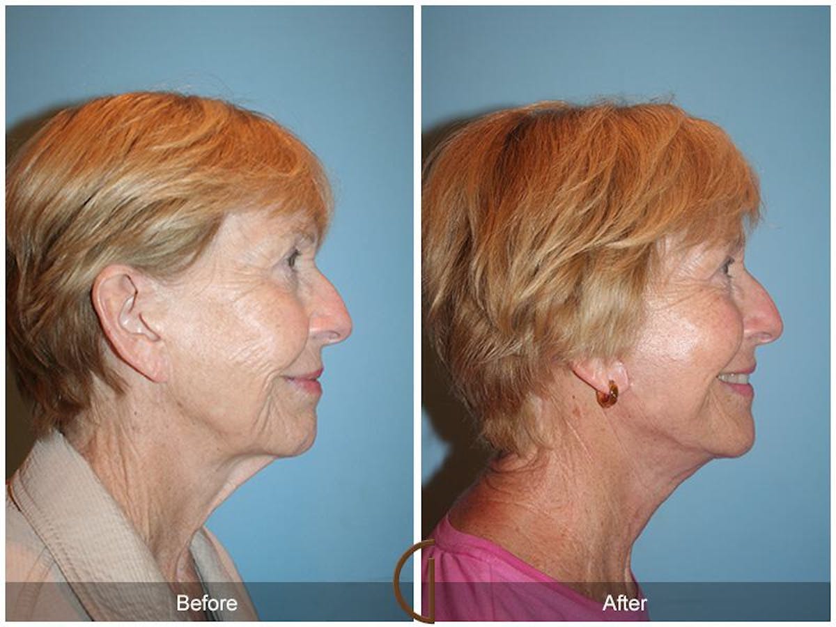 Facelift 70s Before & After Gallery - Patient 336254 - Image 3