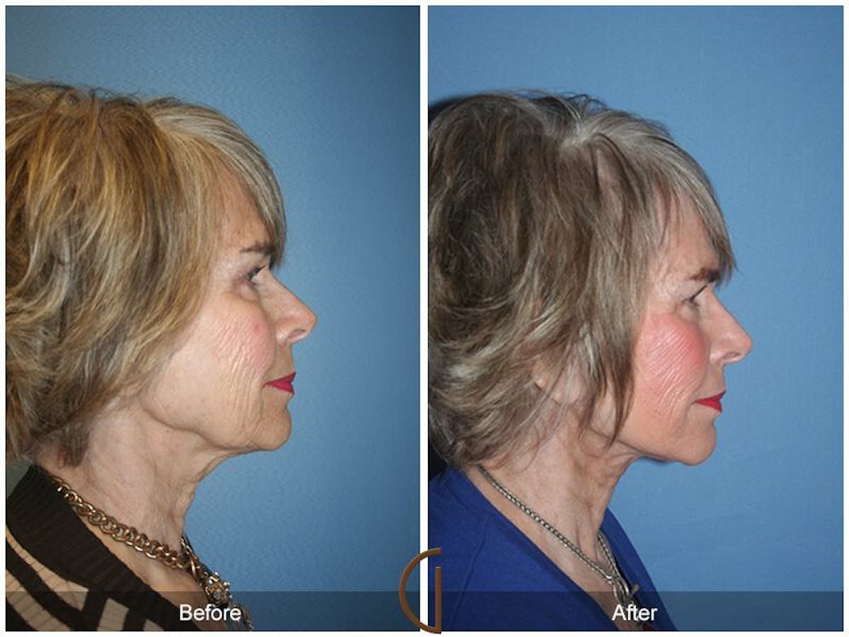 Facelift 70s Before & After Gallery - Patient 198315 - Image 3