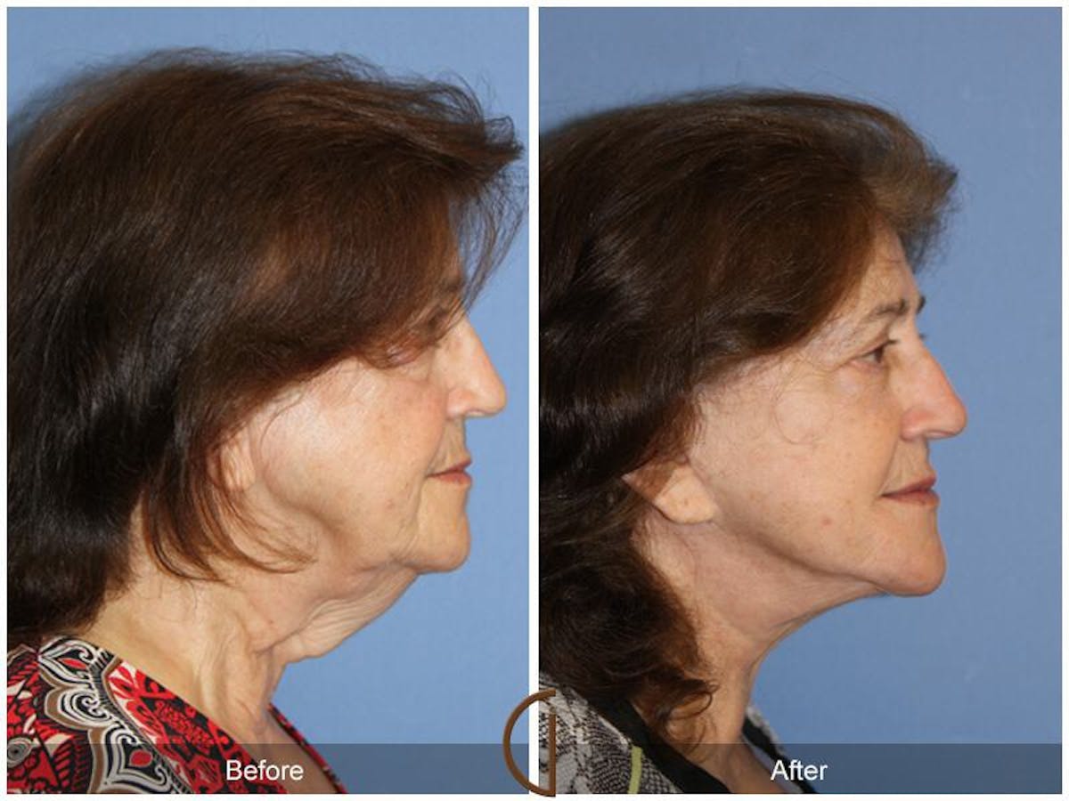 Facelift 70s Before & After Gallery - Patient 396349 - Image 3