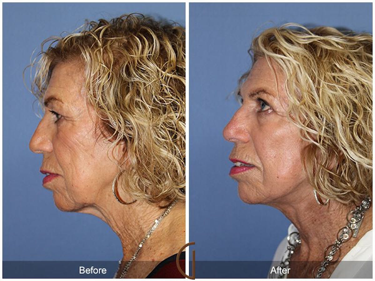 Facelift 70s Before & After Gallery - Patient 324538 - Image 1