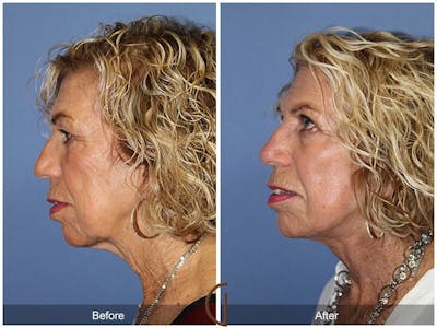 Facelift 70s Before & After Gallery - Patient 324538 - Image 1
