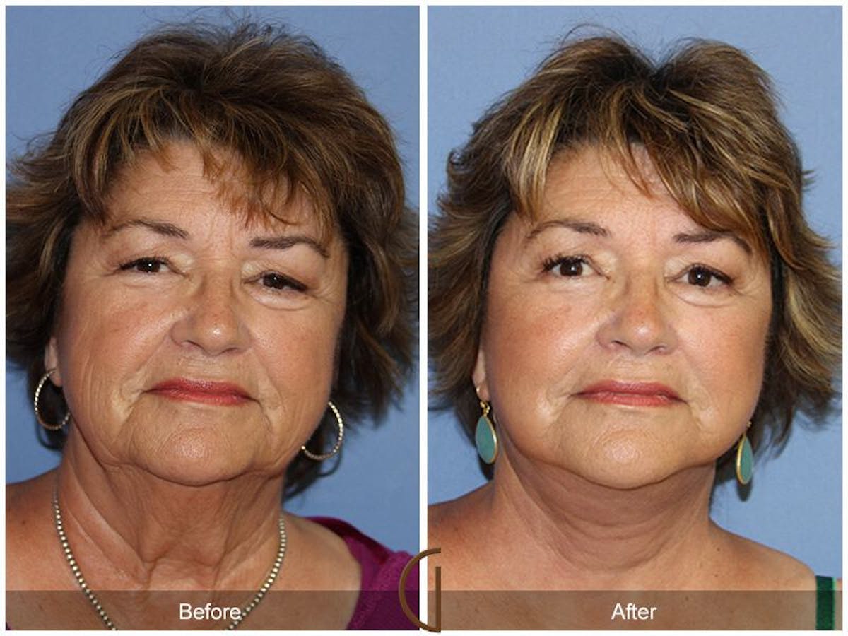 Facelift 70s Before & After Gallery - Patient 407335 - Image 2