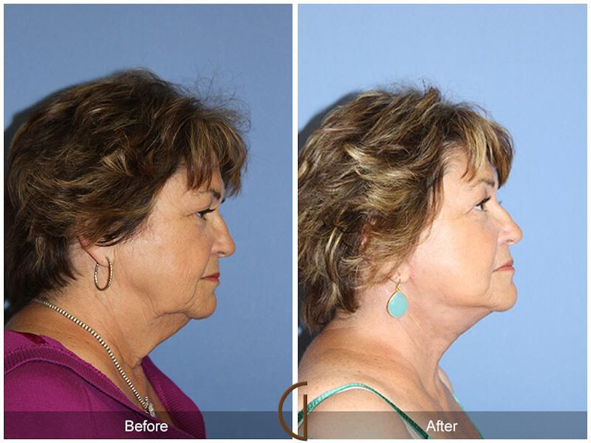 Facelift 70s Before & After Gallery - Patient 407335 - Image 3