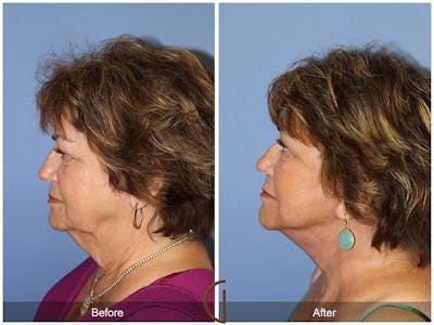 Facelift 70s Before & After Gallery - Patient 407335 - Image 1