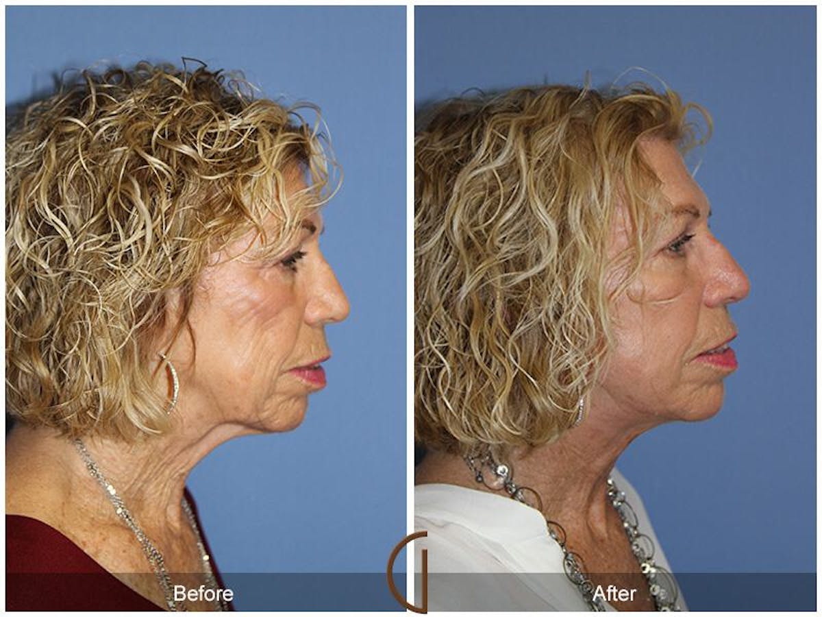 Facelift 70s Before & After Gallery - Patient 324538 - Image 3