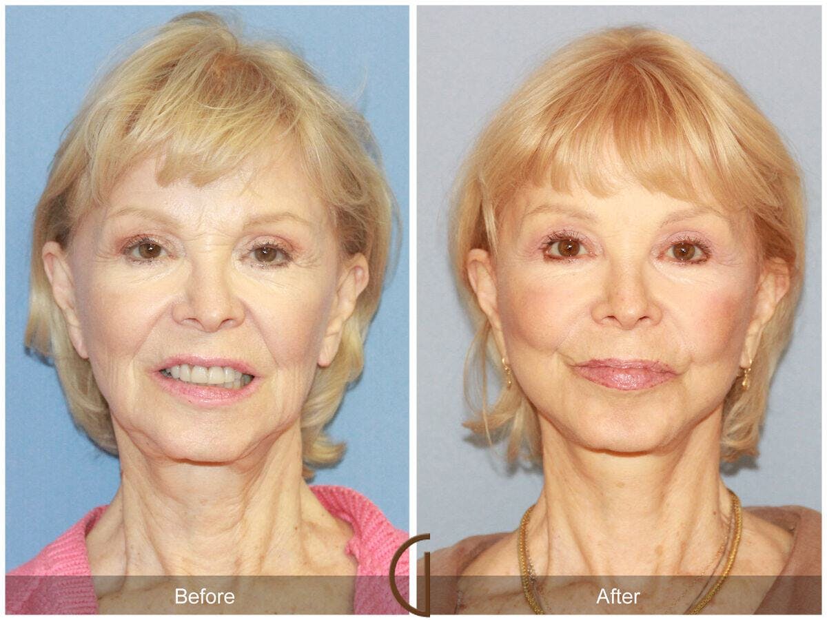 Facelift 70s Before & After Gallery - Patient 298873 - Image 2