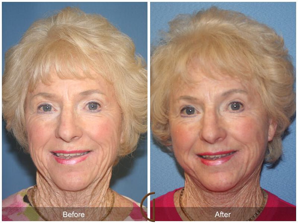 Facelift 70s Before & After Gallery - Patient 132257 - Image 2