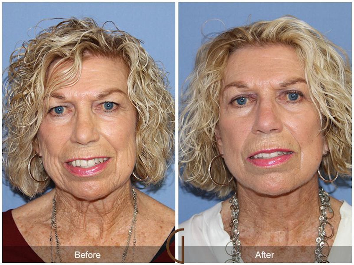 Facelift 70s Before & After Gallery - Patient 324538 - Image 2