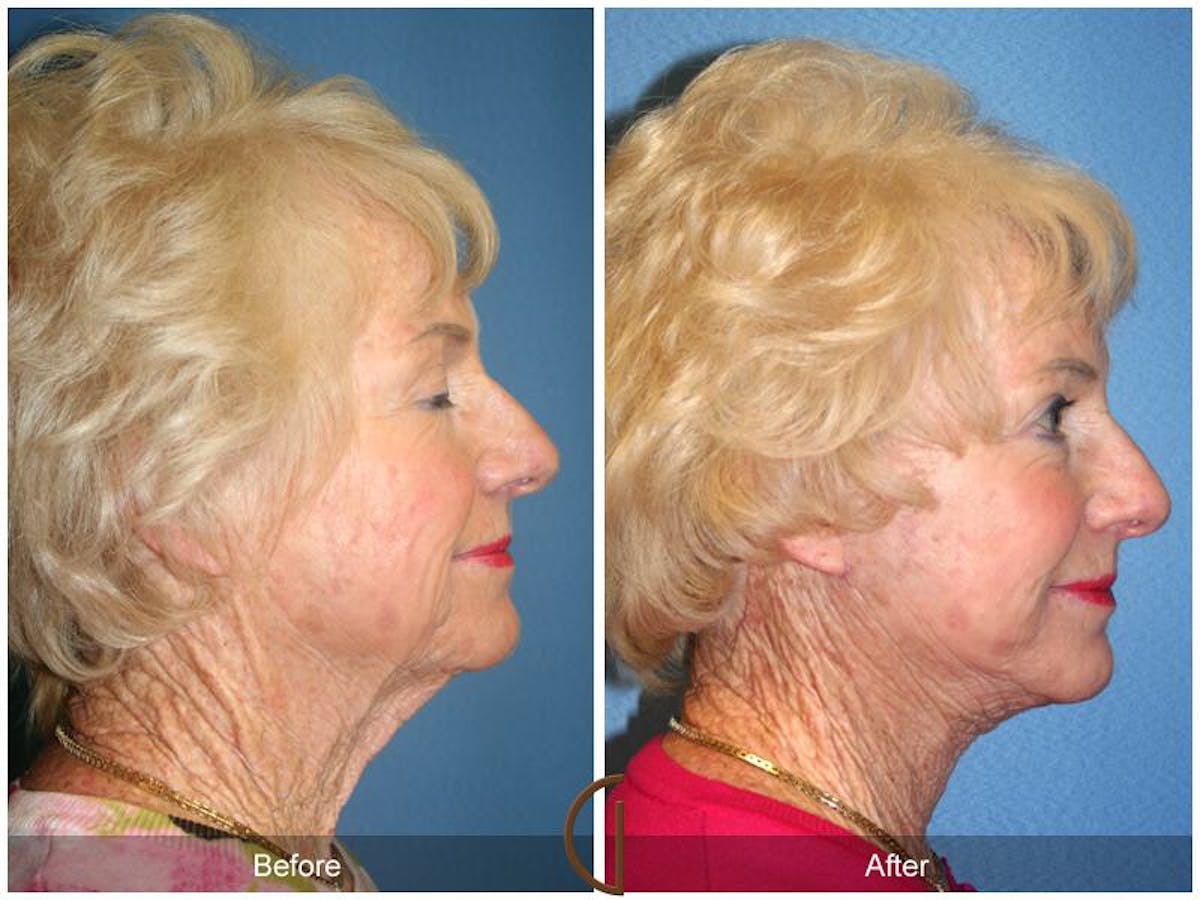 Facelift 70s Before & After Gallery - Patient 132257 - Image 3
