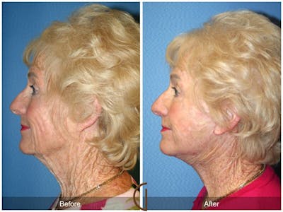 Facelift 70s Before & After Gallery - Patient 132257 - Image 1