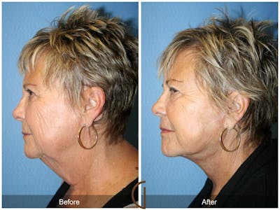 Facelift 70s Before & After Gallery - Patient 247597 - Image 1