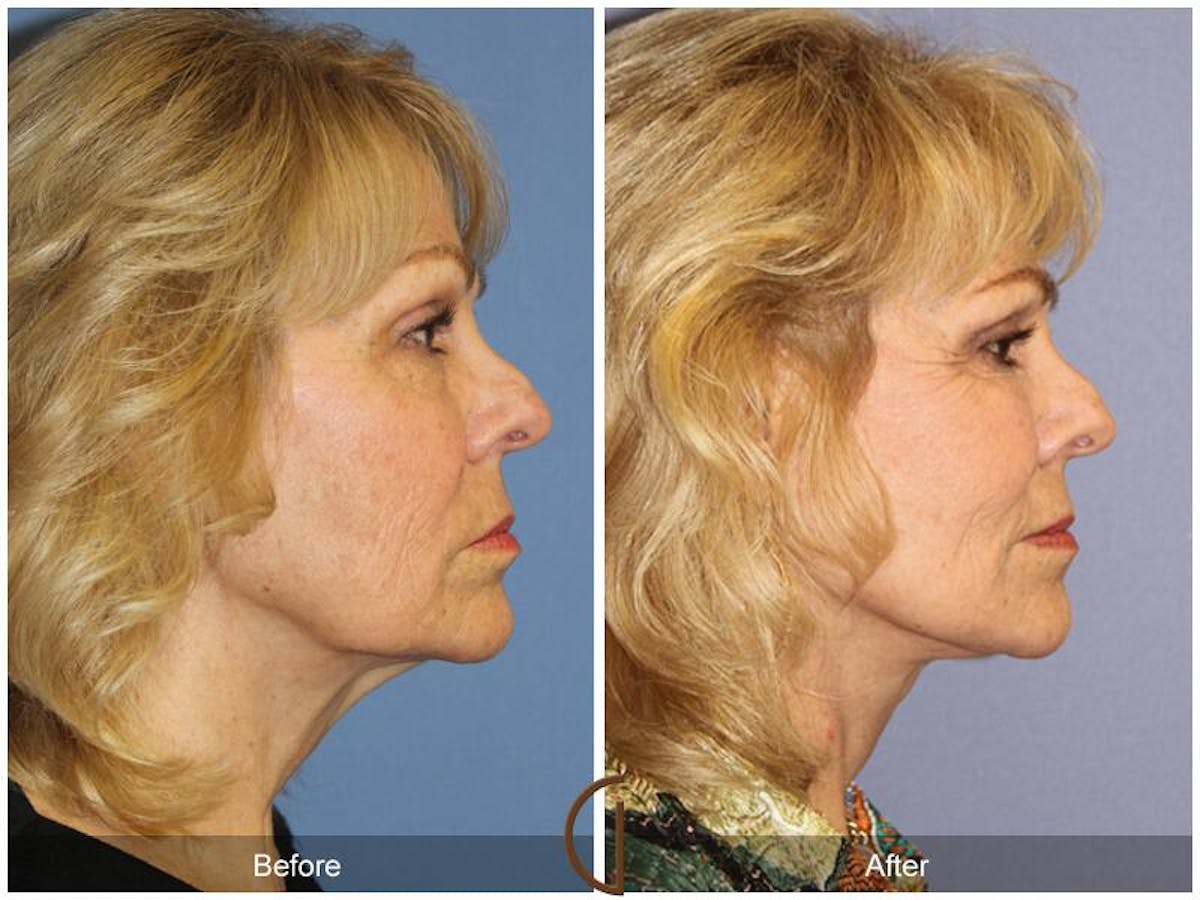 Facelift 70s Before & After Gallery - Patient 293749 - Image 3