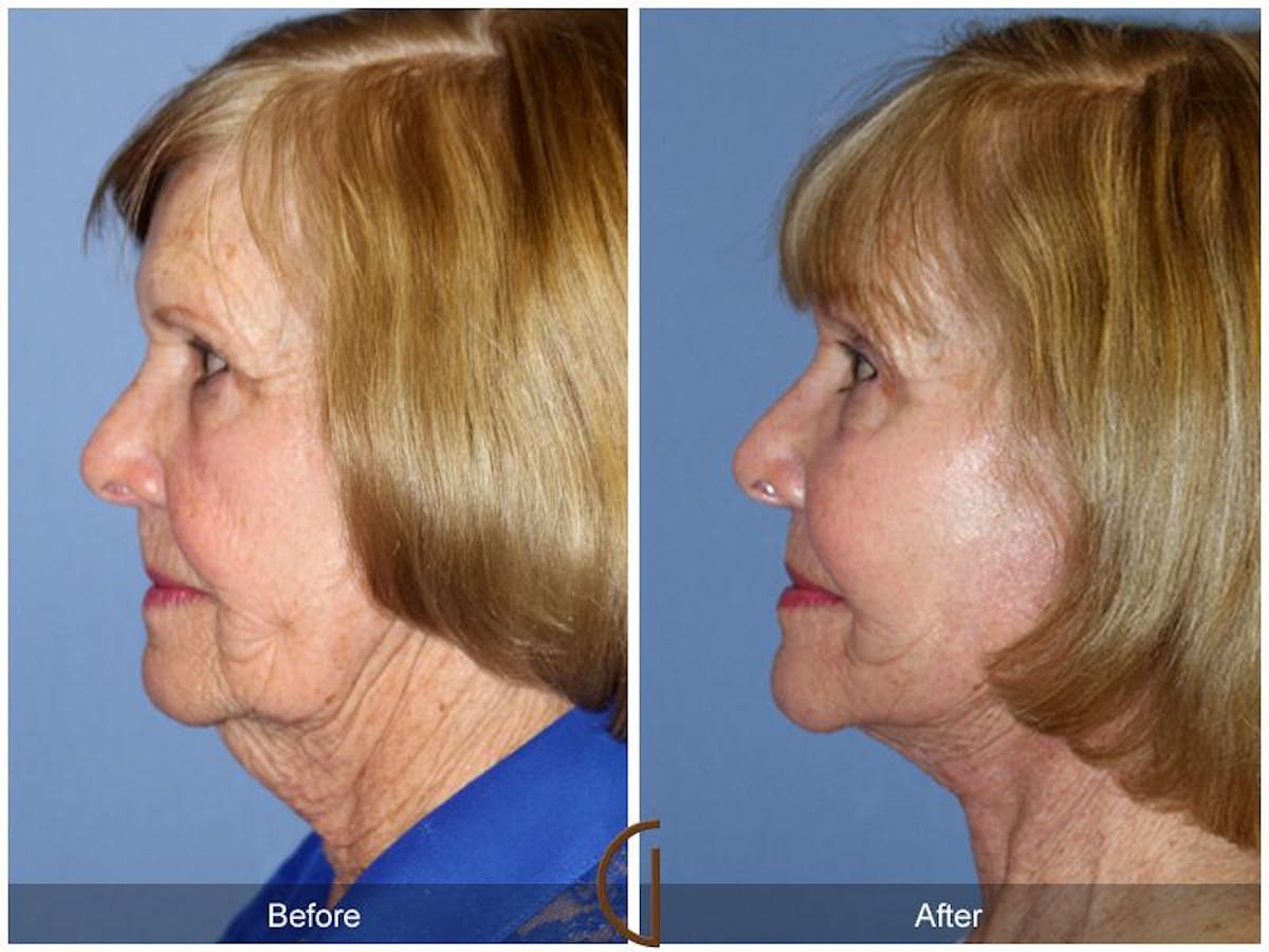 Facelift 70s Before & After Gallery - Patient 591519 - Image 1