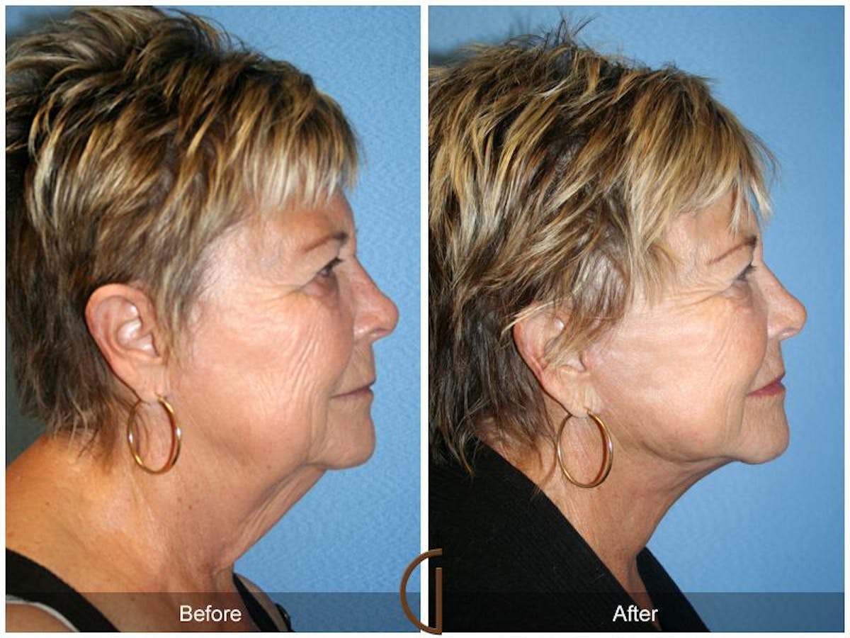 Facelift 70s Before & After Gallery - Patient 247597 - Image 3