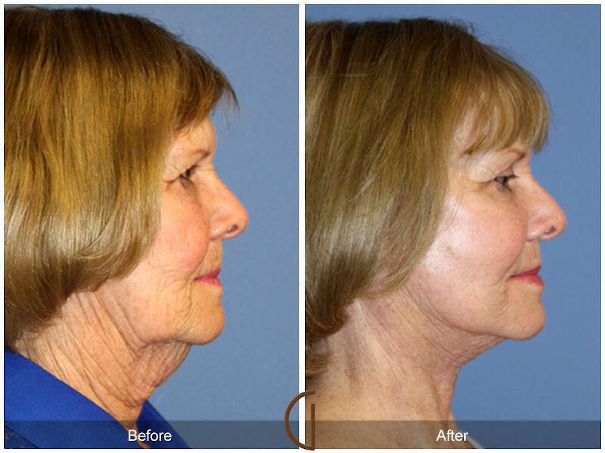 Facelift 70s Before & After Gallery - Patient 591519 - Image 3